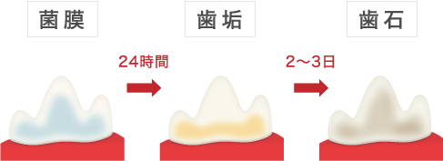 食後 歯の表面に菌膜が形成され、その24時間後には歯垢になり、さらに2～3日後には歯石となります。